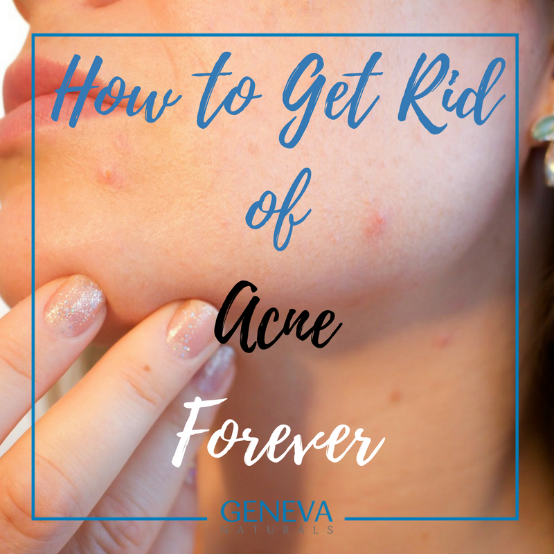 get rid of acne forever