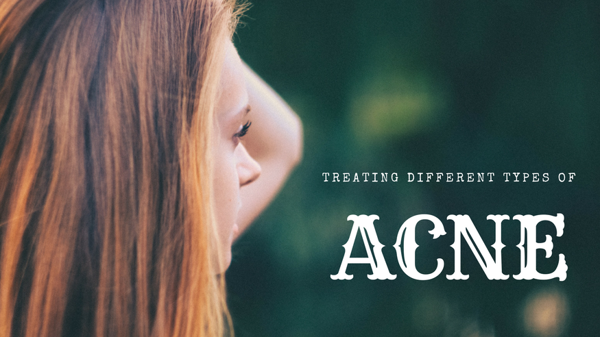 treating different types of acne